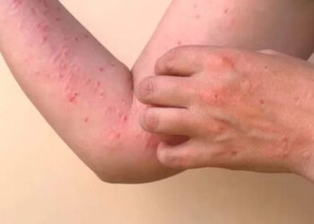 Viruela del mono: detectaron 11 casos nuevos en la Argentina