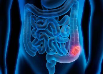 El cáncer colorrectal puede detectarse a través de un test gratuito