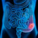 El cáncer colorrectal puede detectarse a través de un test gratuito