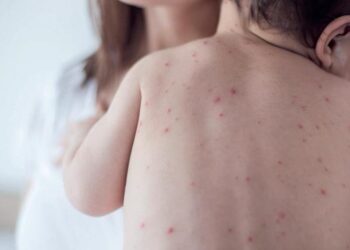 Refuerzan medidas preventivas en Misiones por nuevos casos de sarampión